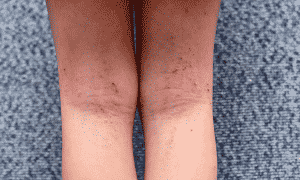 Different types of allergies - A child with Eczema in her legs