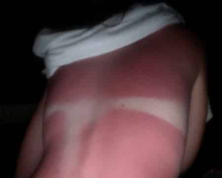 Dangers of electromagnetic radiaion - A sunburn